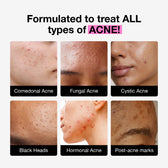 Acne Serum - FDA-approved, medicated Acne Serum with Salicylic Acid ...